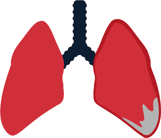 Mesothelioma And Asbestos Exposure Infographic Elg Law