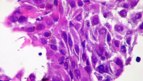 Squamous Cell Carcinoma Patients, at High Risk for Contracting the New