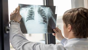 The shortness of breath caused by asbestos exposure wrongly attributed to congestive heart failure (CHF)
