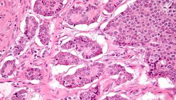 Neuroendocrine tumors and asbestos exposure