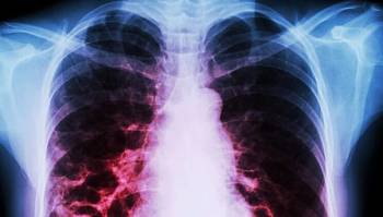 Atelectasis, lung cancer and asbestos exposure