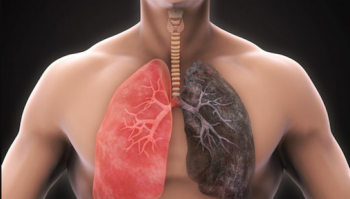 What patients with interstitial lung disease should know