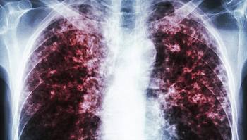 Is pulmonary tuberculosis associated with asbestos-related diseases?