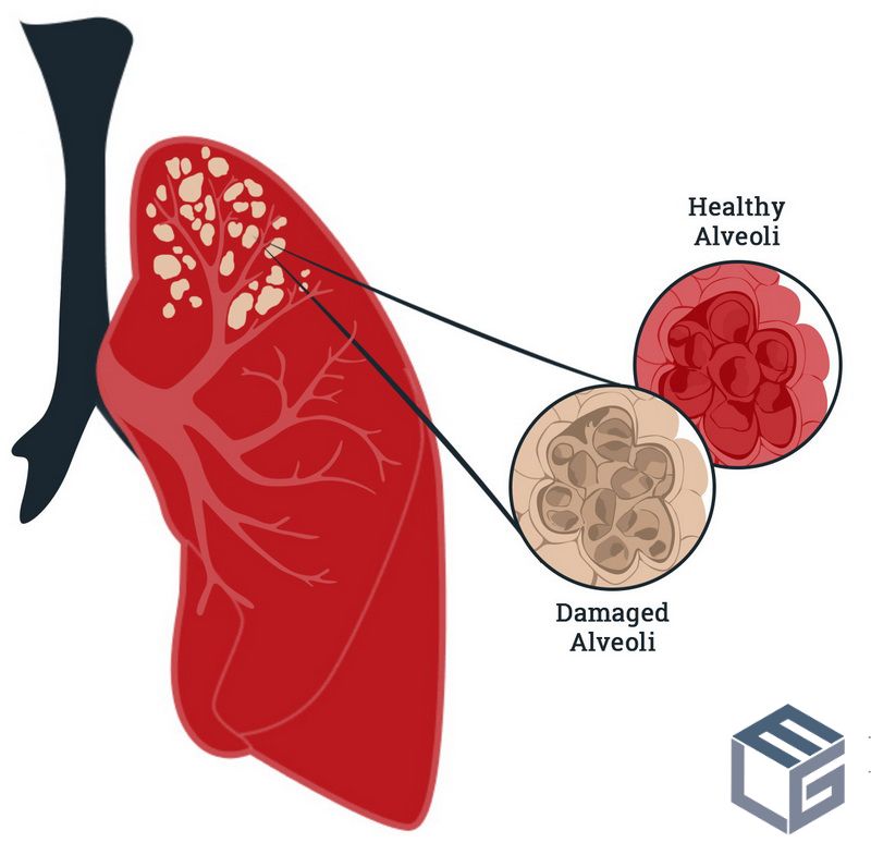 Emphysema Lawyers Asbestos Exposure ELG Law