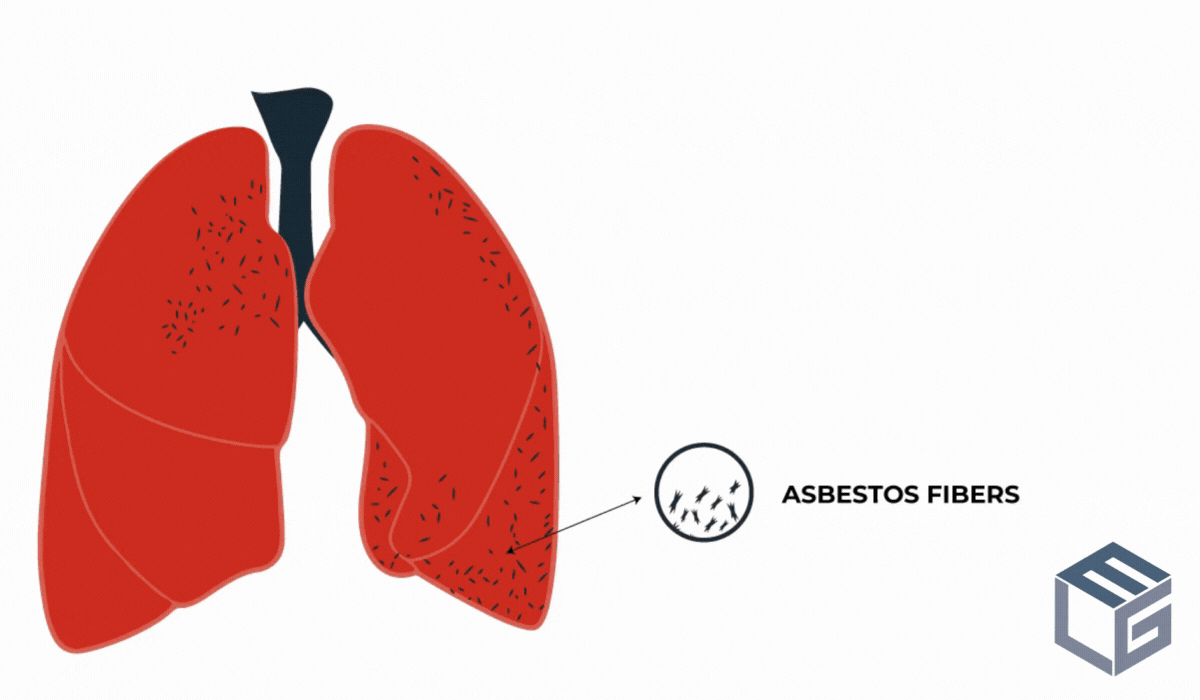 copd stage 2 prognosis