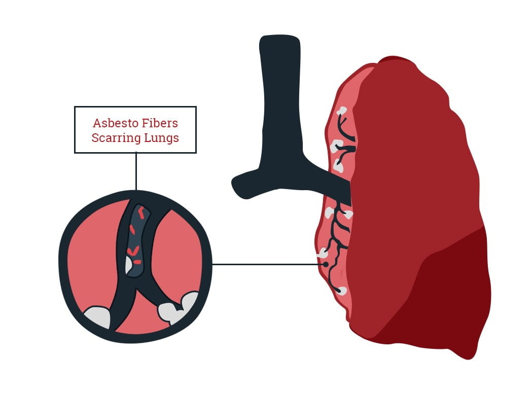 Smoking and Asbestos Exposure | ELG Law