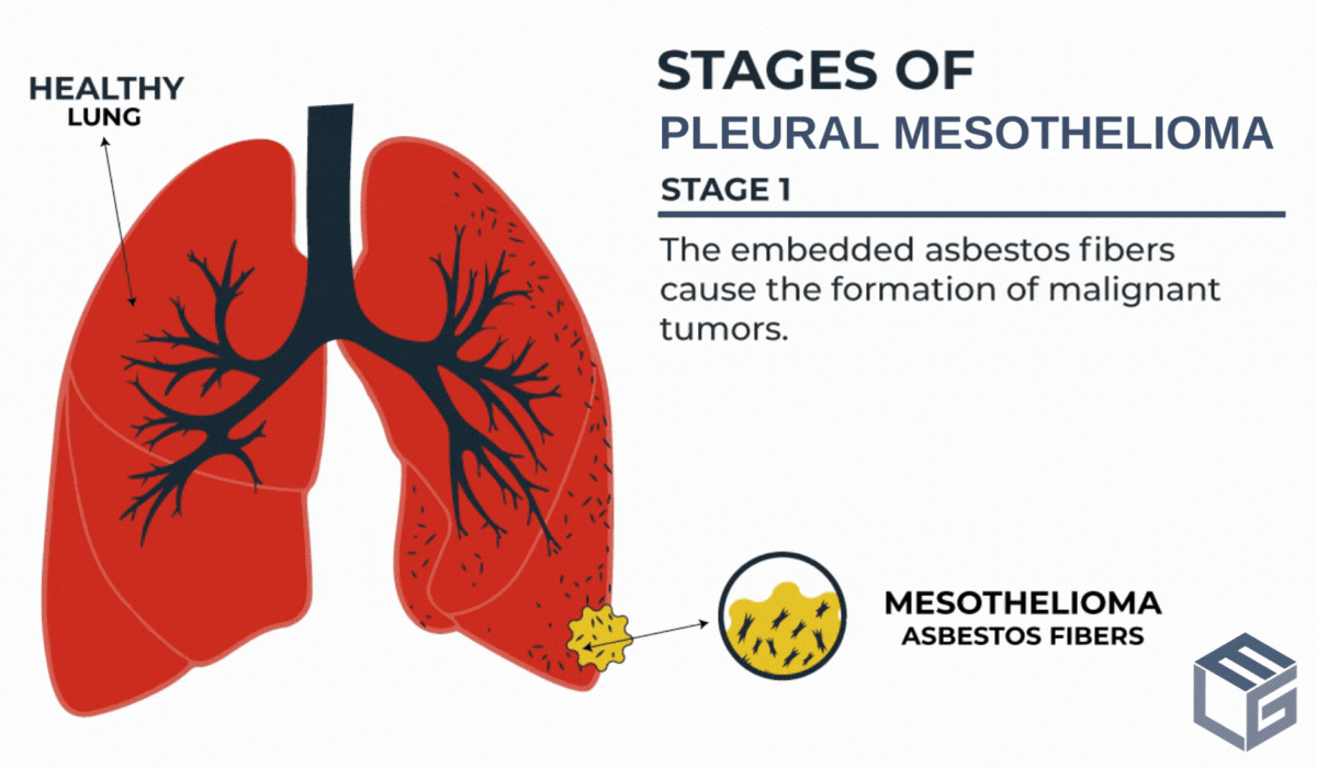 mesothelioma and liver cancer