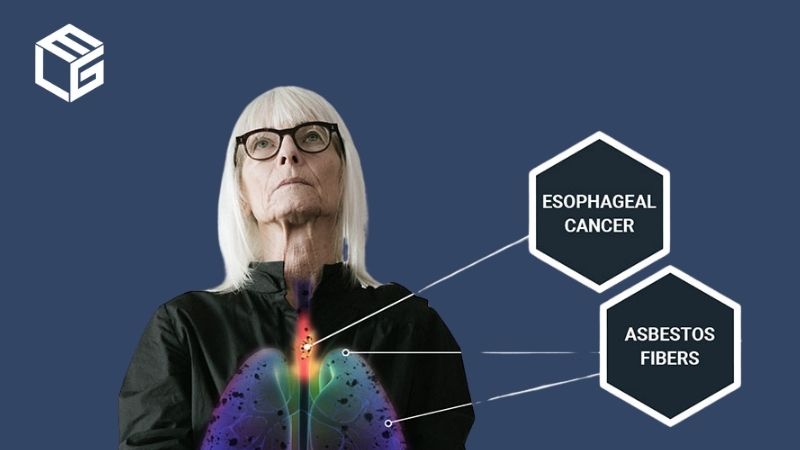 Esophageal cancer misdiagnosis