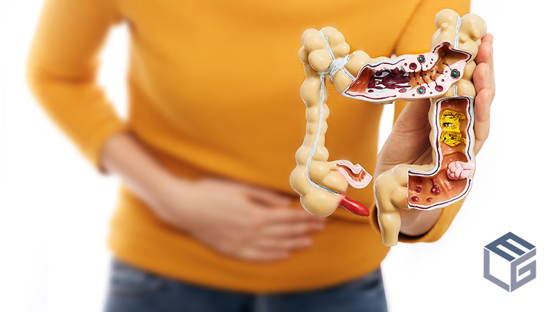 Ulcerative colitis:  A VA-recognized Disability