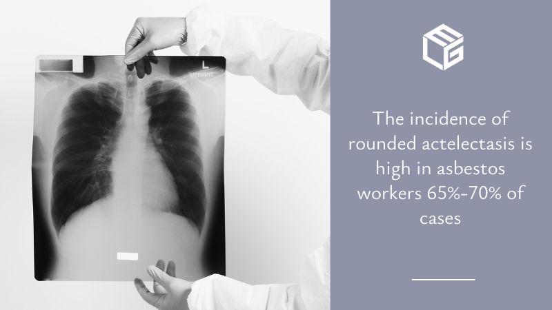 Rounded atelectasis due to asbestos exposure video
