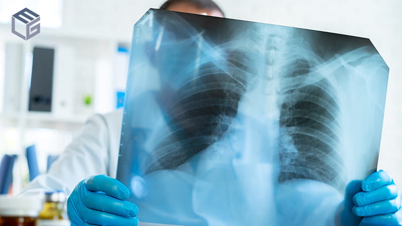 Neuroendocrine tumors of the lung and asbestos exposure