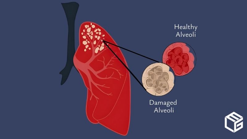 Emphysema due to asbestos exposure video