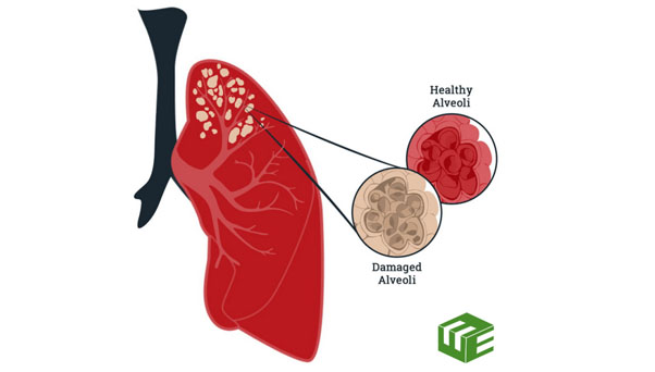 What You Need to Know About Emphysema Misdiagnosis and Asbestos-Related