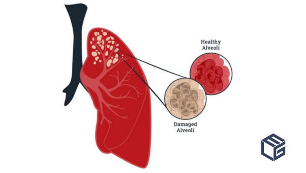 What you need to know about emphysema misdiagnosis and asbestos-related diseases