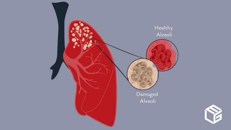 Emphysema due to asbestos exposure video
