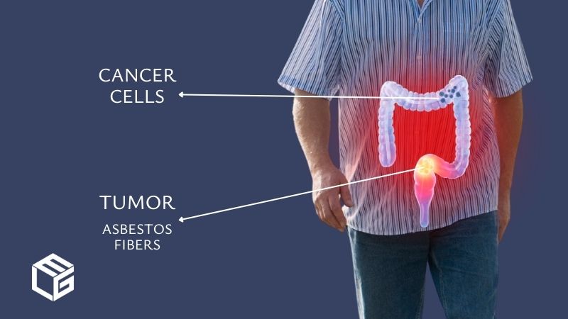  Asbestos gastrointestinal/ stomach cancer claims video