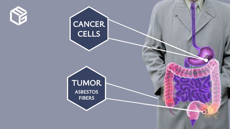  Asbestos gastrointestinal/ stomach cancer claims video