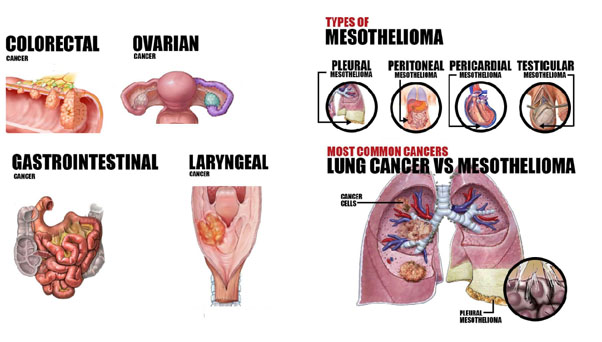 what is the life expectancy for stage 4 liver cancer