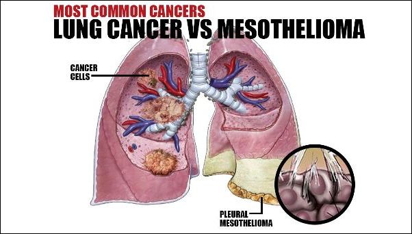 Lung Cancer vs. Mesothelioma | ELG Law