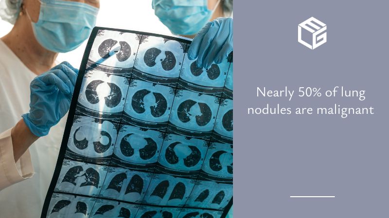 Lung nodules due to asbestos exposure video