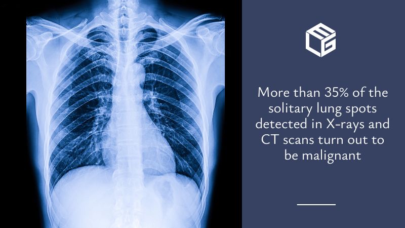  Lung spots due to asbestos exposure video