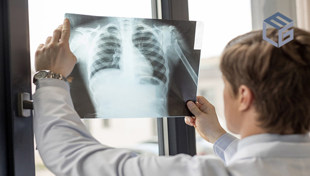 The shortness of breath caused by asbestos exposure wrongly attributed to congestive heart failure (CHF)