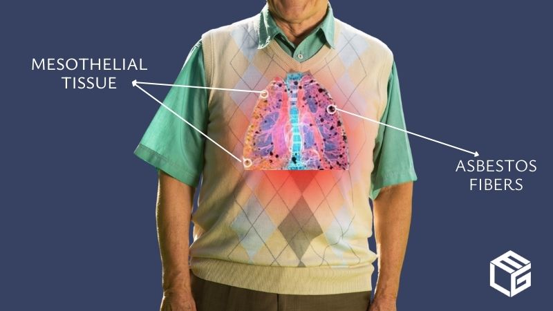 Mesothelioma claims video