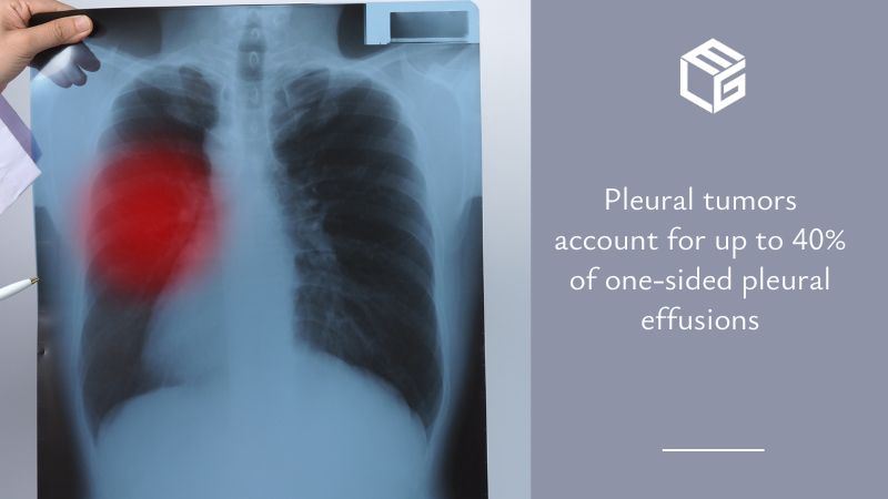 Pleural effusion video
