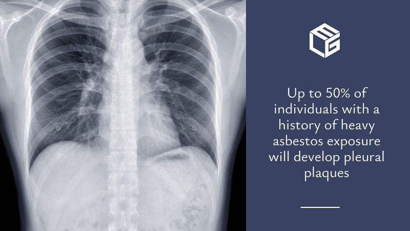 Pleural plaques due to asbestos exposure video
