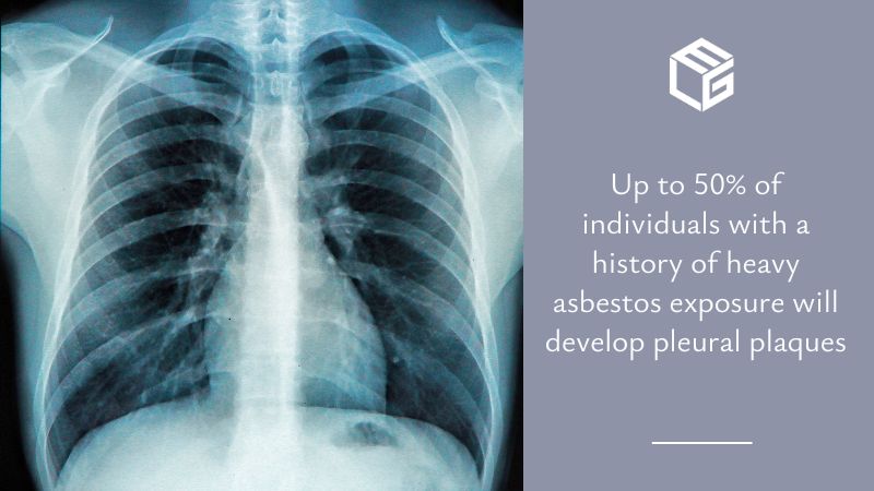 Pleural plaques due to asbestos exposure video