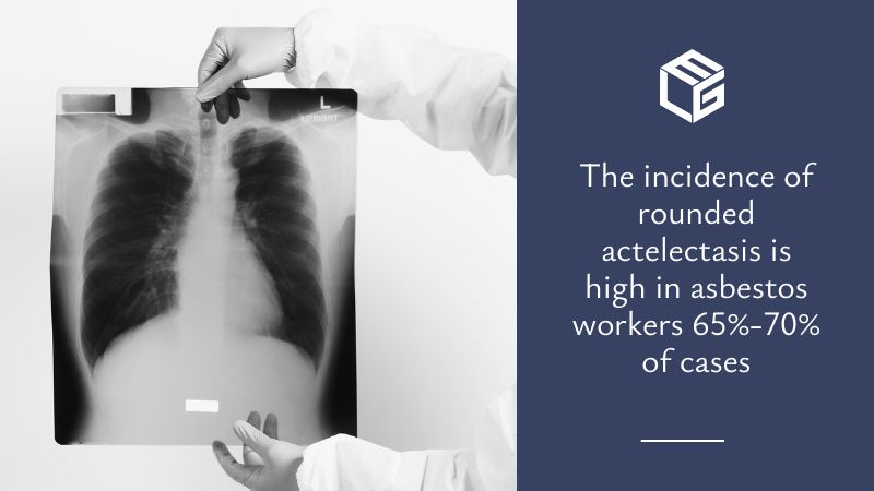 Rounded atelectasis due to asbestos exposure video