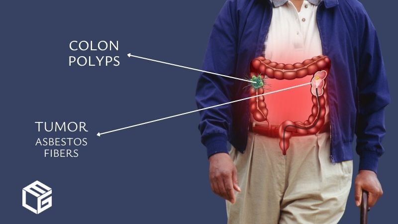 Asbestos colorectal cancer claims video