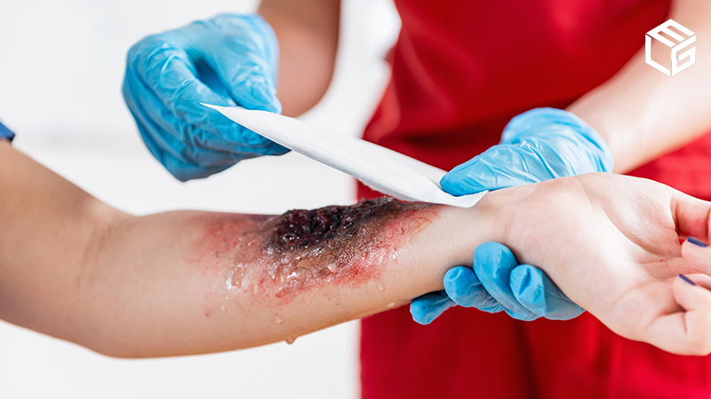 Catastrophic burns: Do you qualify for a FELA claim?