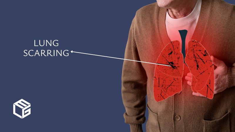 Lung scarring due to asbestos exposure video