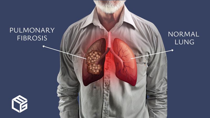 Pulmonary fibrosis due to asbestos exposure video