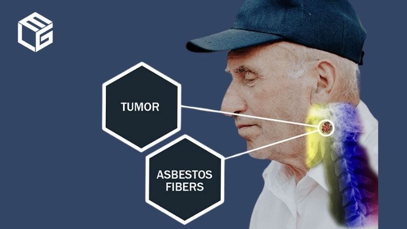 Asbestos throat cancer claims video