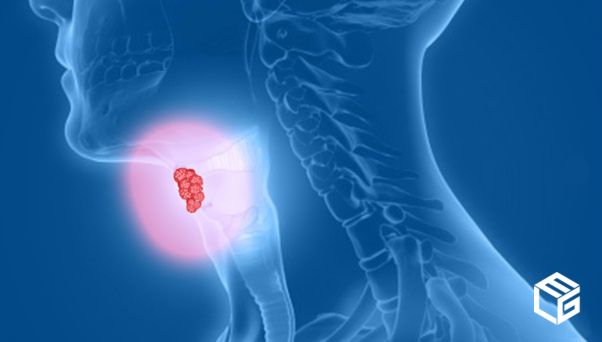 Managing the costs of asbestos-related throat cancer treatment