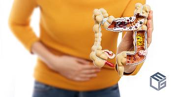 Ulcerative colitis:  A VA-recognized Disability
