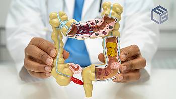 PFOA linked to ulcerative colitis